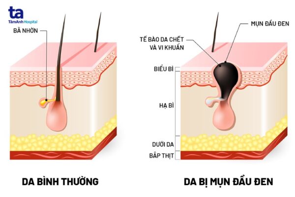 tuyen ba nhon hoat dong manh