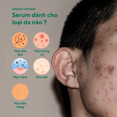 Serum Giảm Mụn Mờ Thâm ARDAN dành cho loại da nào?
